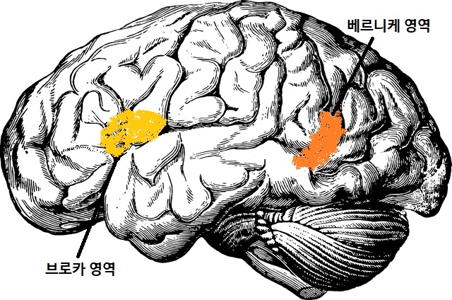브로카 실어증, 베르니케 실저응